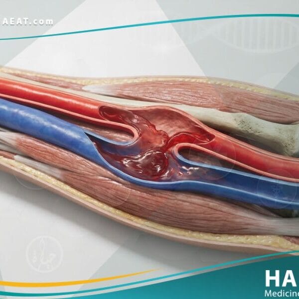 الناسور الشرياني الوريدي