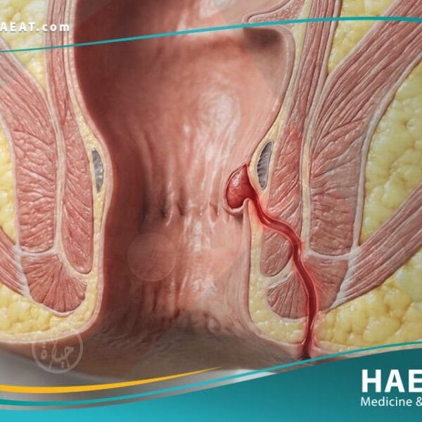 الناسور في فتحة الشرج