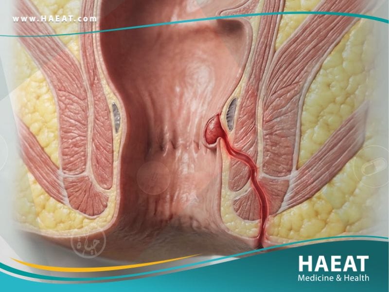الناسور في فتحة الشرج