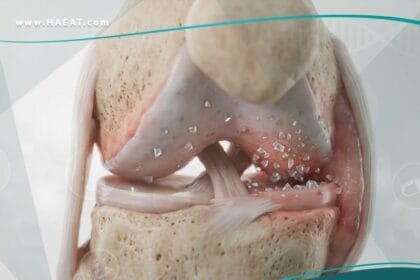 _النقرس الكاذب