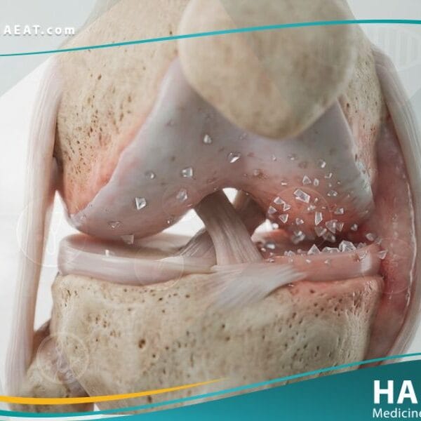 _النقرس الكاذب