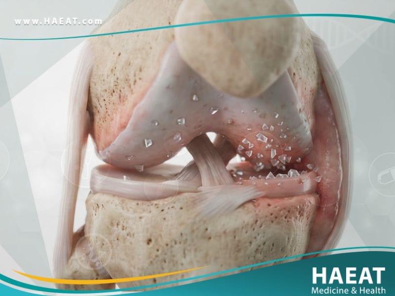 _النقرس الكاذب