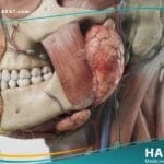 النكاف