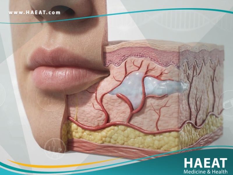 الوذمة الوعائية