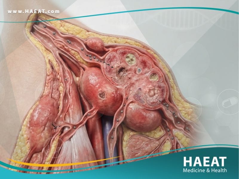 الورم الحبيبي اللمفي المنقول جنسيا