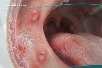 _امراض الاغشية المخاطية للفم