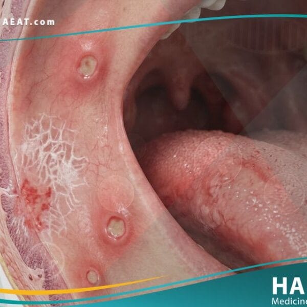 _امراض الاغشية المخاطية للفم