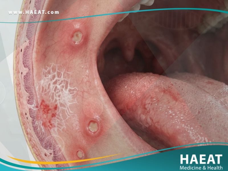 _امراض الاغشية المخاطية للفم