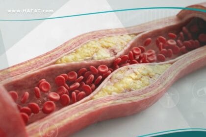 انسداد الشرايين