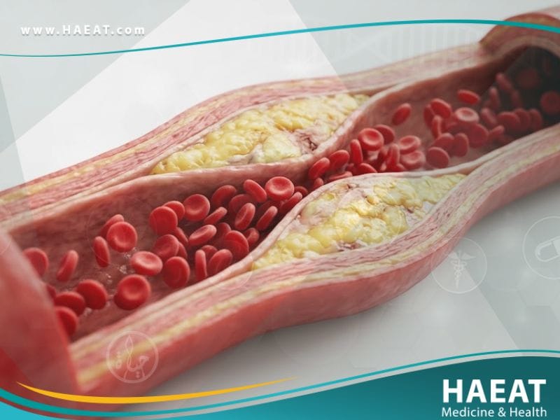 انسداد الشرايين