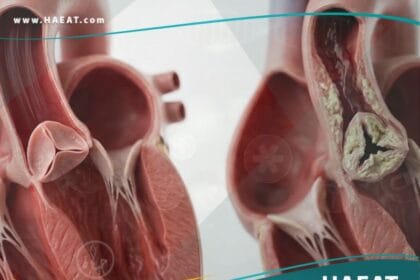 تضيق الصمام الابهري