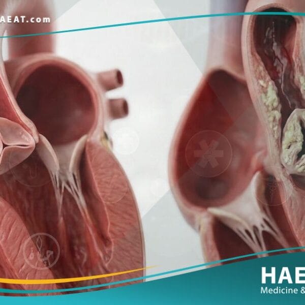 تضيق الصمام الابهري