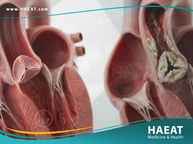 تضيق الصمام الابهري