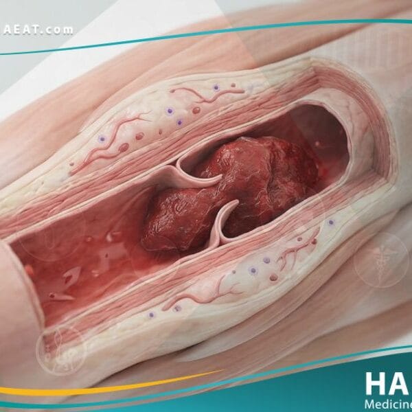 خثار الأوردة العميقة