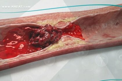 خثارٌ شرياني