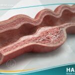 خلل التنسج الليفي العضلي