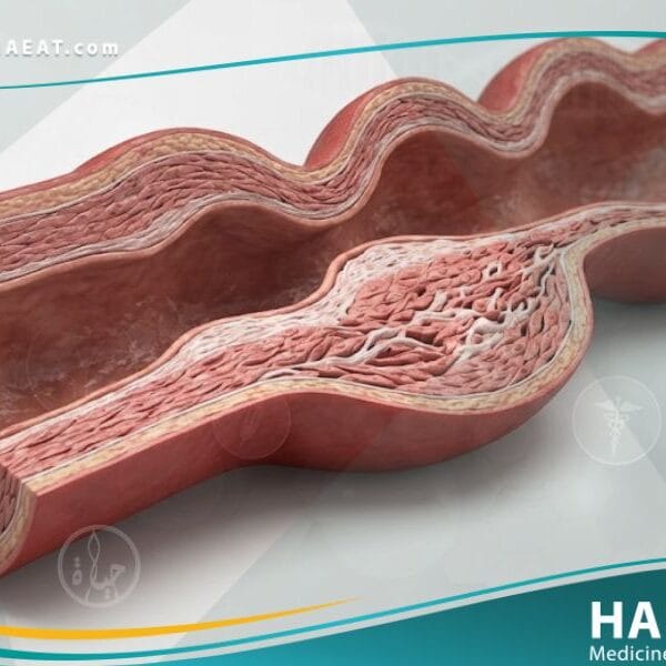 خلل التنسج الليفي العضلي