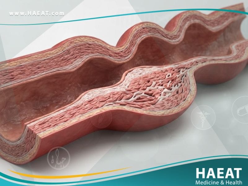 خلل التنسج الليفي العضلي