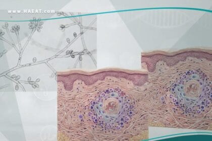 داء الشعريات المبوغة