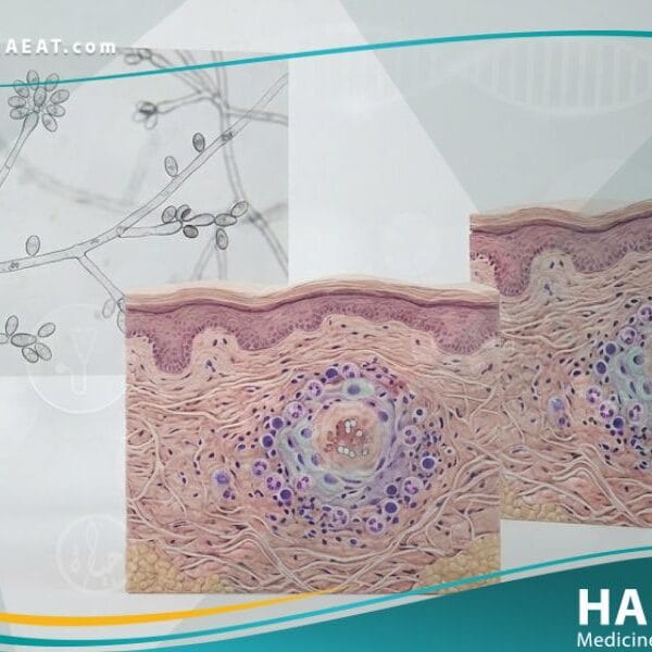 داء الشعريات المبوغة