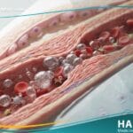 _داء الغواص