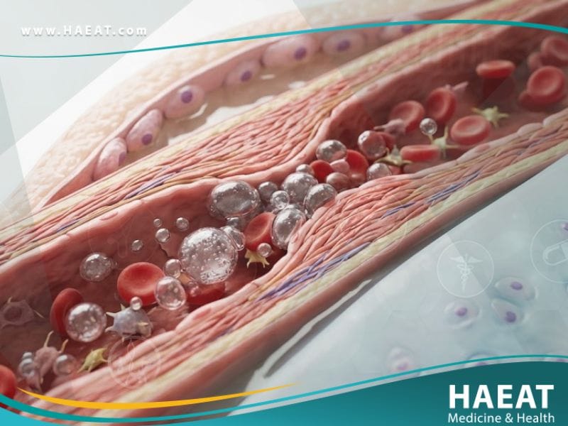 _داء الغواص