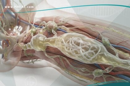 _داء الفيلاريات