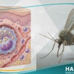 _داء الليشمانيات