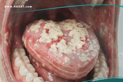 _داء المبيضات الفموي