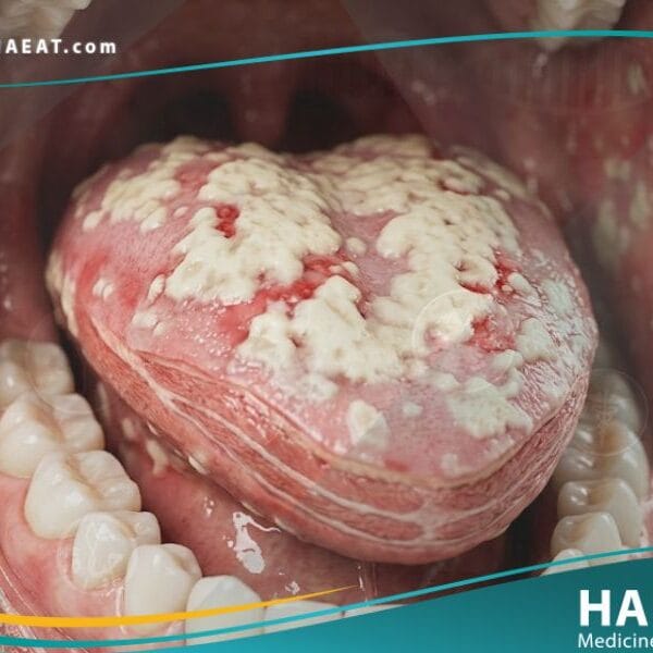 _داء المبيضات الفموي