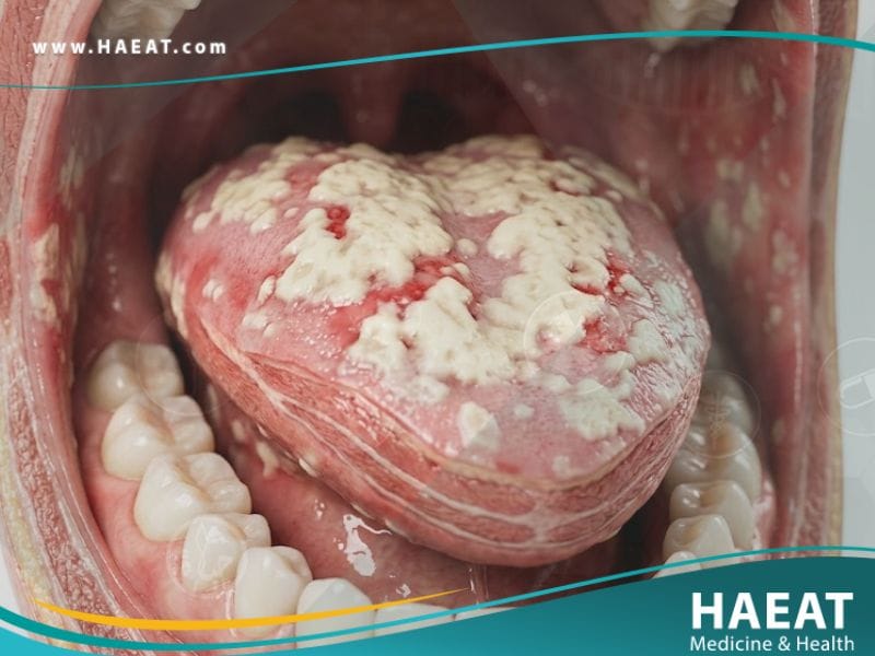 _داء المبيضات الفموي