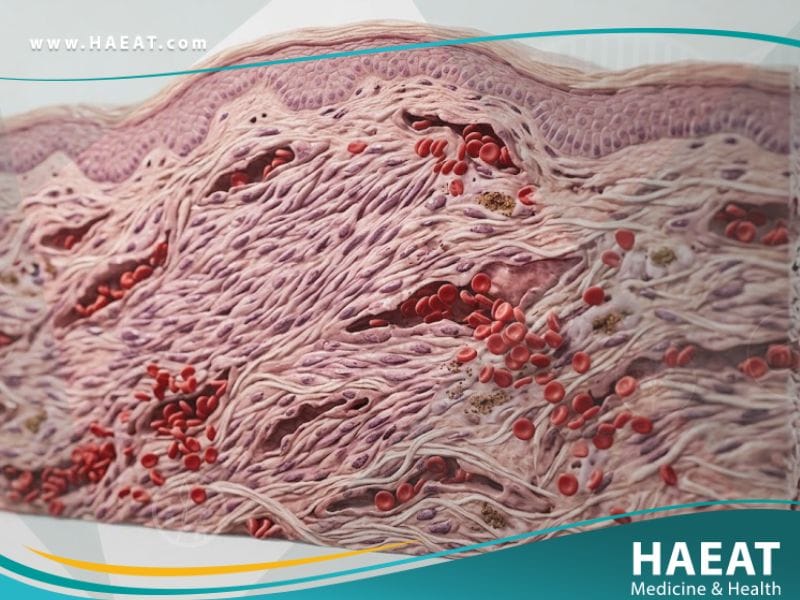 ساركوما كابوزي