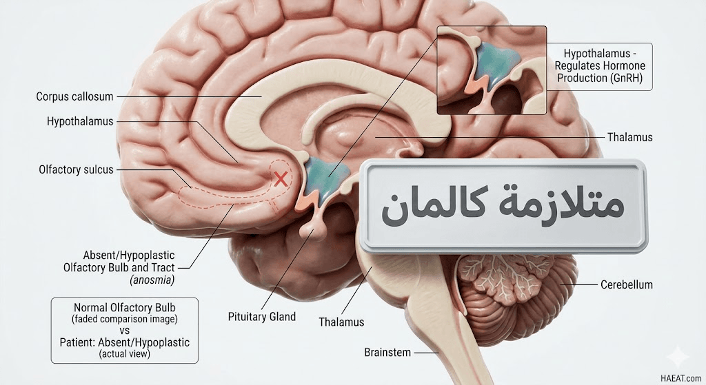 متلازمة كالمان | 9 أعراض، أسباب، وعوامل الخطر 20 image 599