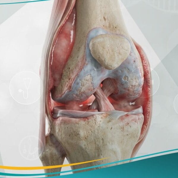 آلام المفاصل