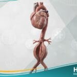 أم الدم الأبهرية