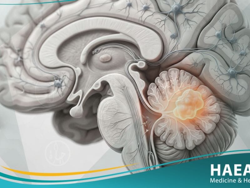 _أورام الدماغ لدى الأطفال