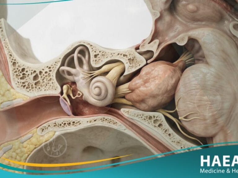 _أورام العصب السمعي