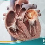 _أورام قلبية