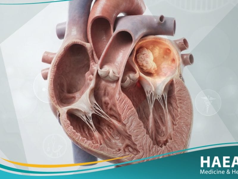 _أورام قلبية