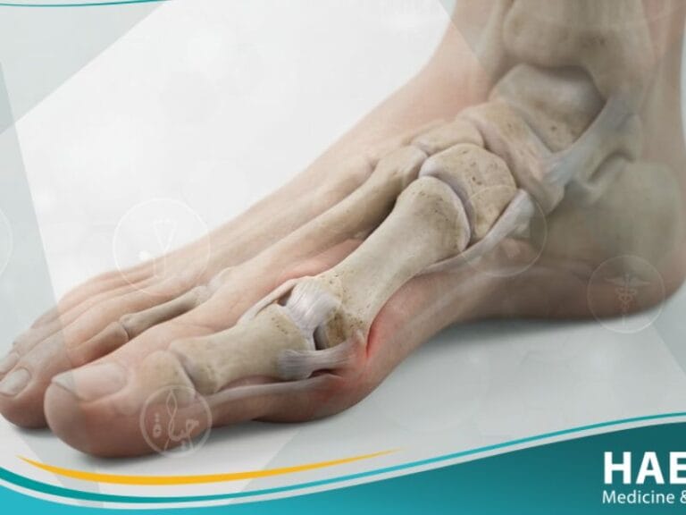 _إبهام القدم الأروح