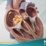 إحصار القلب