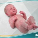 إصابة بردٍ وليدية