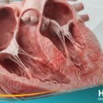 إلتهاب عضلة القلب