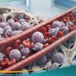 _ابيضاض الدم النقوي الحاد