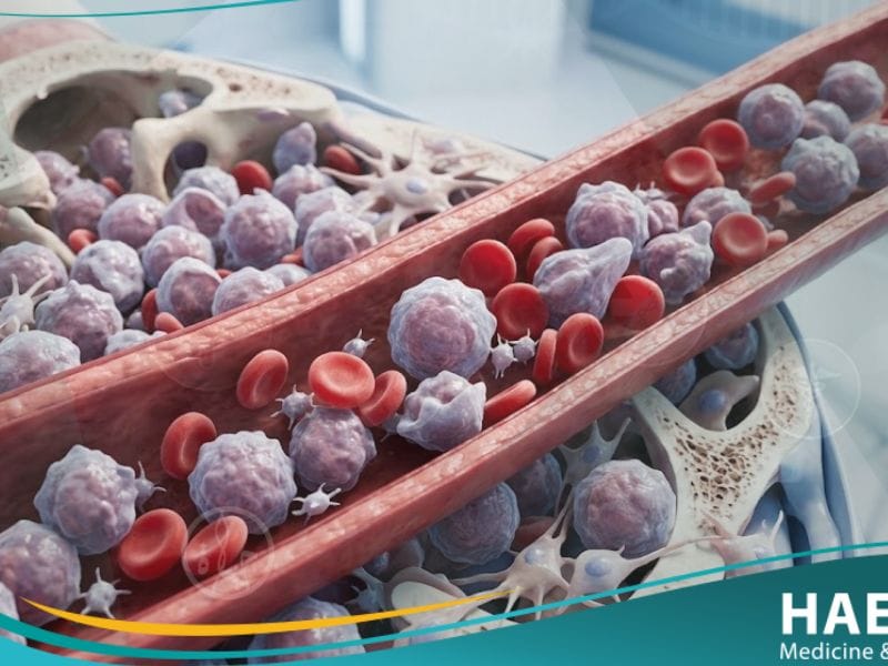 _ابيضاض الدم النقوي الحاد