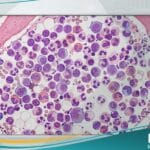 ابيضاض الدم النقوي المزمن