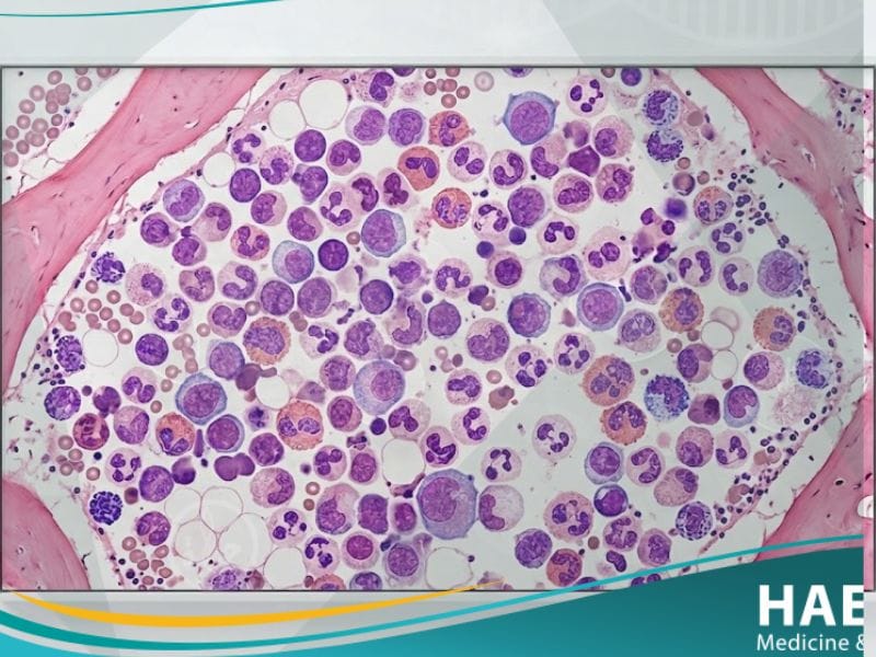 ابيضاض الدم النقوي المزمن