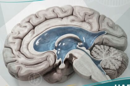 استسقاء دماغي