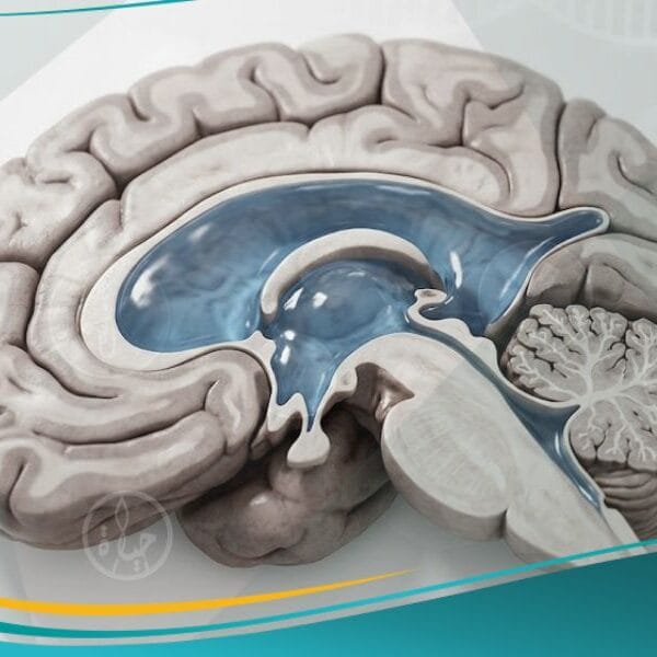 استسقاء دماغي