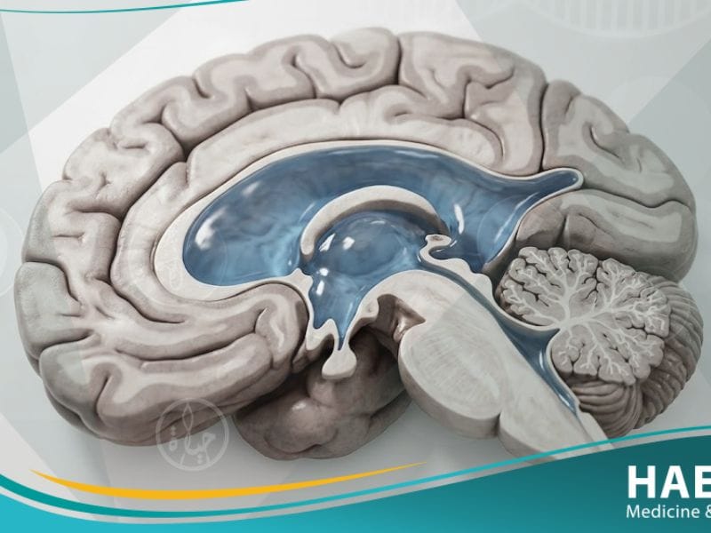 استسقاء دماغي